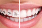 女人40岁能矫正牙齿吗？