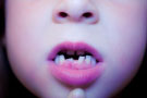 正在换牙的小孩可不可以矫正牙齿？