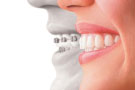 一般矫正牙齿多少钱？