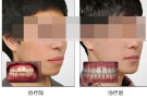 治疗龅牙的最新方法？