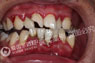 重度牙周病案例