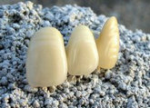 纯钛烤瓷牙价格