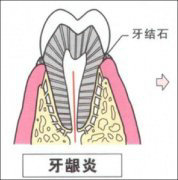 儿童牙龈炎的类型有哪些？