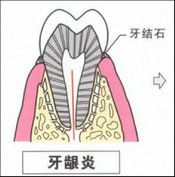 儿童牙龈炎的类型