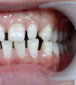 经典推荐》牙齿稀疏四大症状