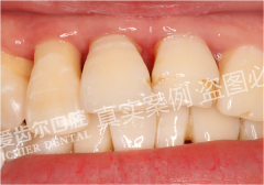 牙龈红肿牙周治疗修复案例